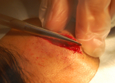 對釘在錯誤位置的壓碎傷口邊緣進行清創術。