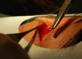 A derme é suturada para eliminar o espaço morto, para que a superfície da ferida se encaixe perfeitamente.