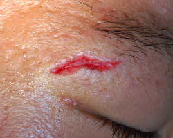 Pro-boxer cut wound.