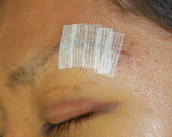 Gently apply and protect the wound strip on the wound. Postoperative care is also important.